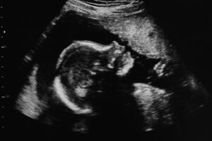 abortion